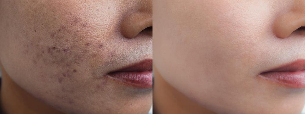 What's the Best Laser Treatment for Brown Spots? - UVTREAT